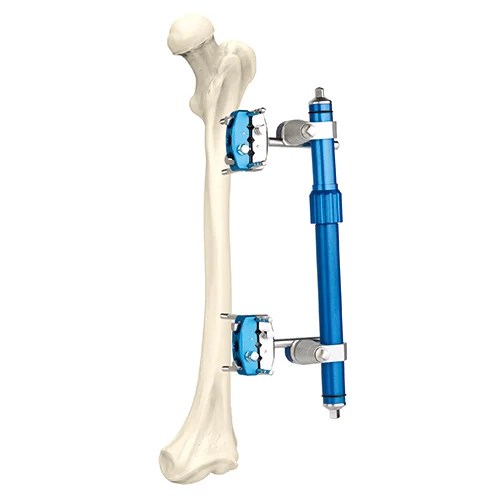 Femoral External Fixator