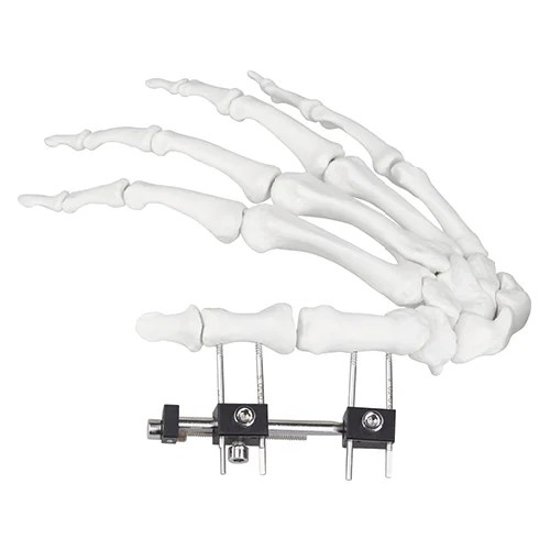 Mini Fragment External Fixator (Finger and Palm)